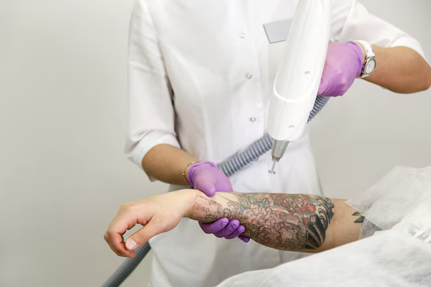 4 tattoo removal services sydney